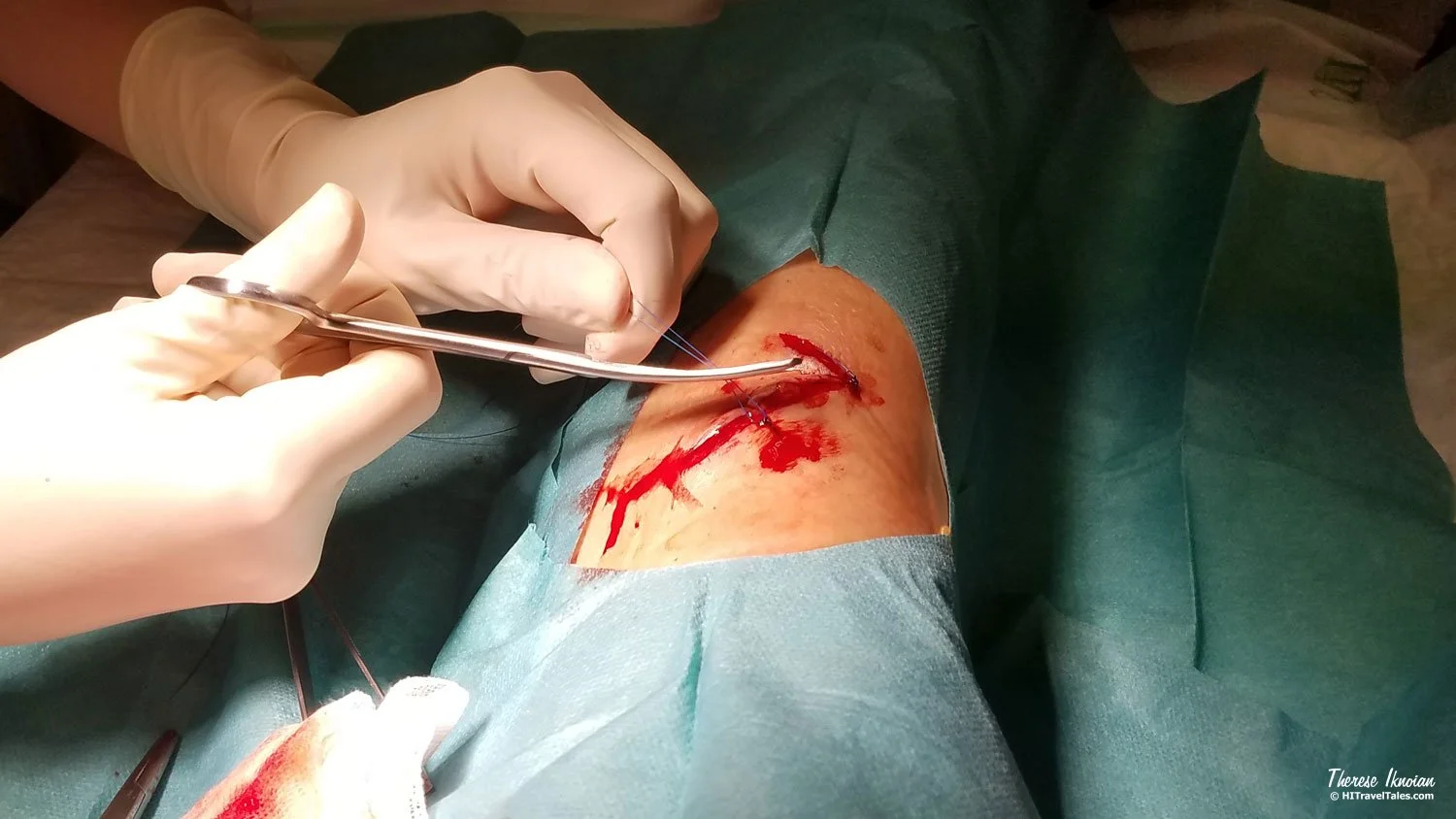 Hands in surgical gloves applying stitches to a gash in a leg.