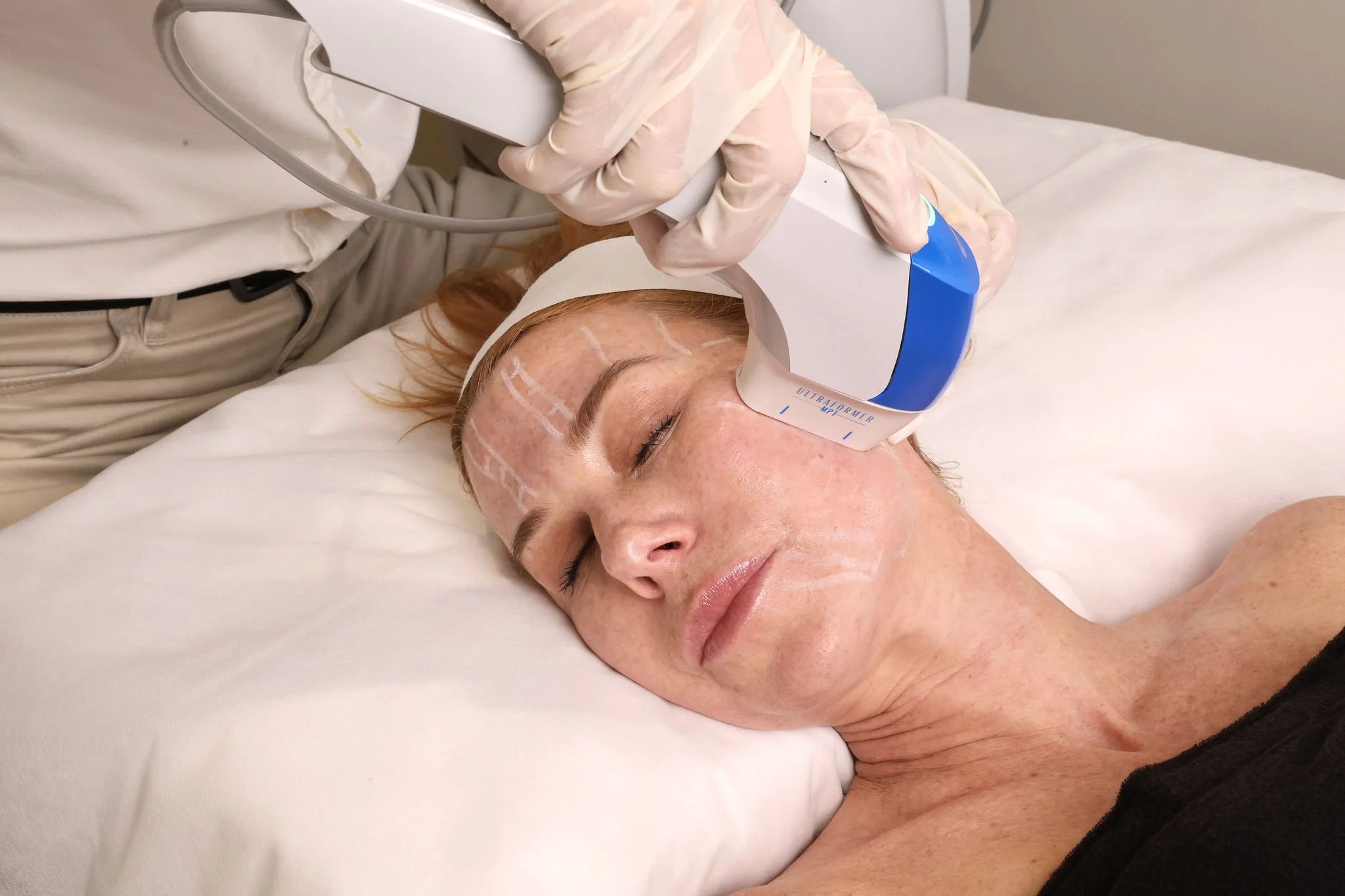 A woman lying on a bed with her eyes closed while a medical professional performs a facial treatment with a blue and white ultrasonic device.