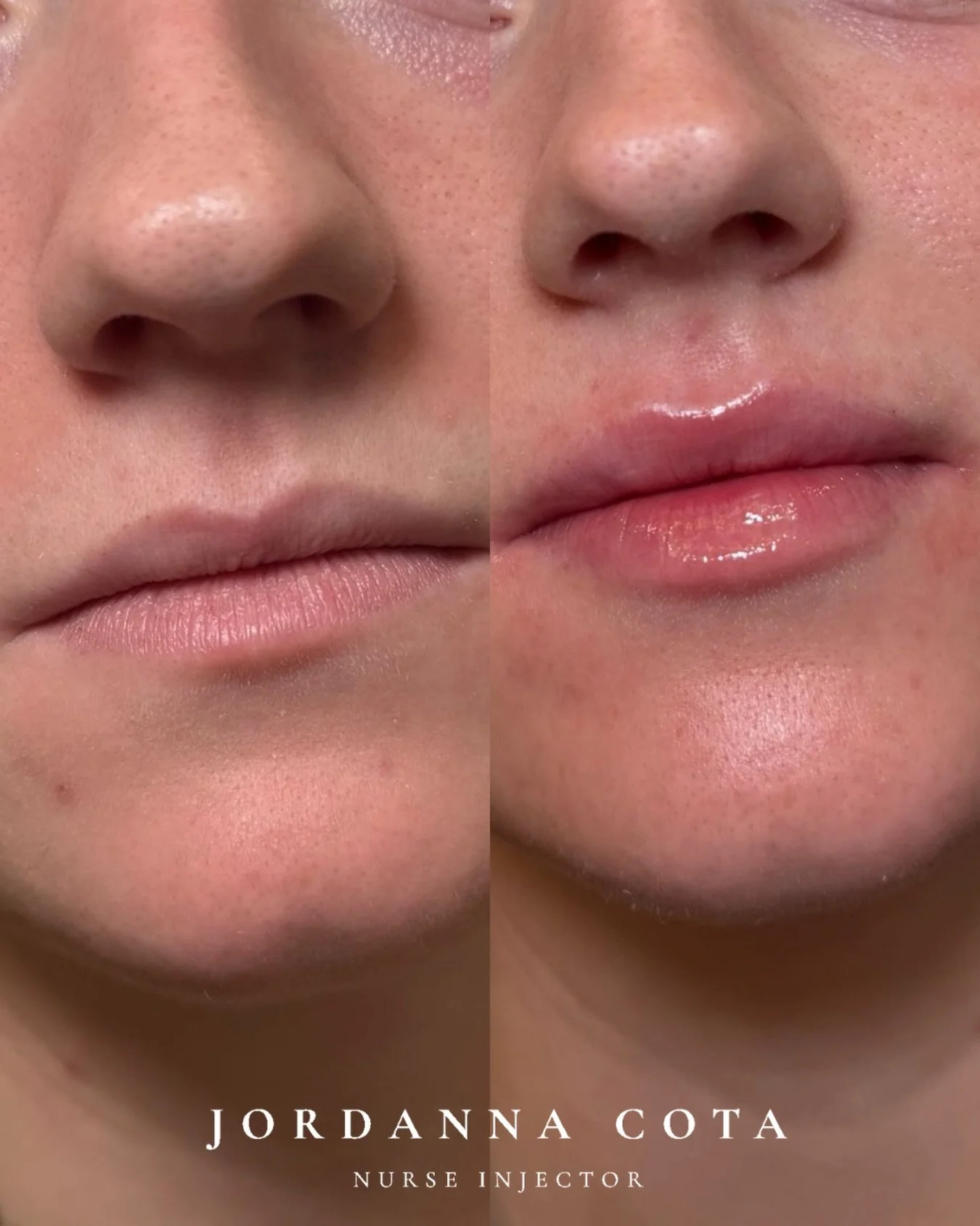 adding today&rsquo;s lips to the favorites folder💌💉
&bull;

&bull;

&bull;

Disclaimer: Before &amp; after images are shared with informed, written patient consent. Results vary and are not guaranteed. Images are for educational and illustrative pu