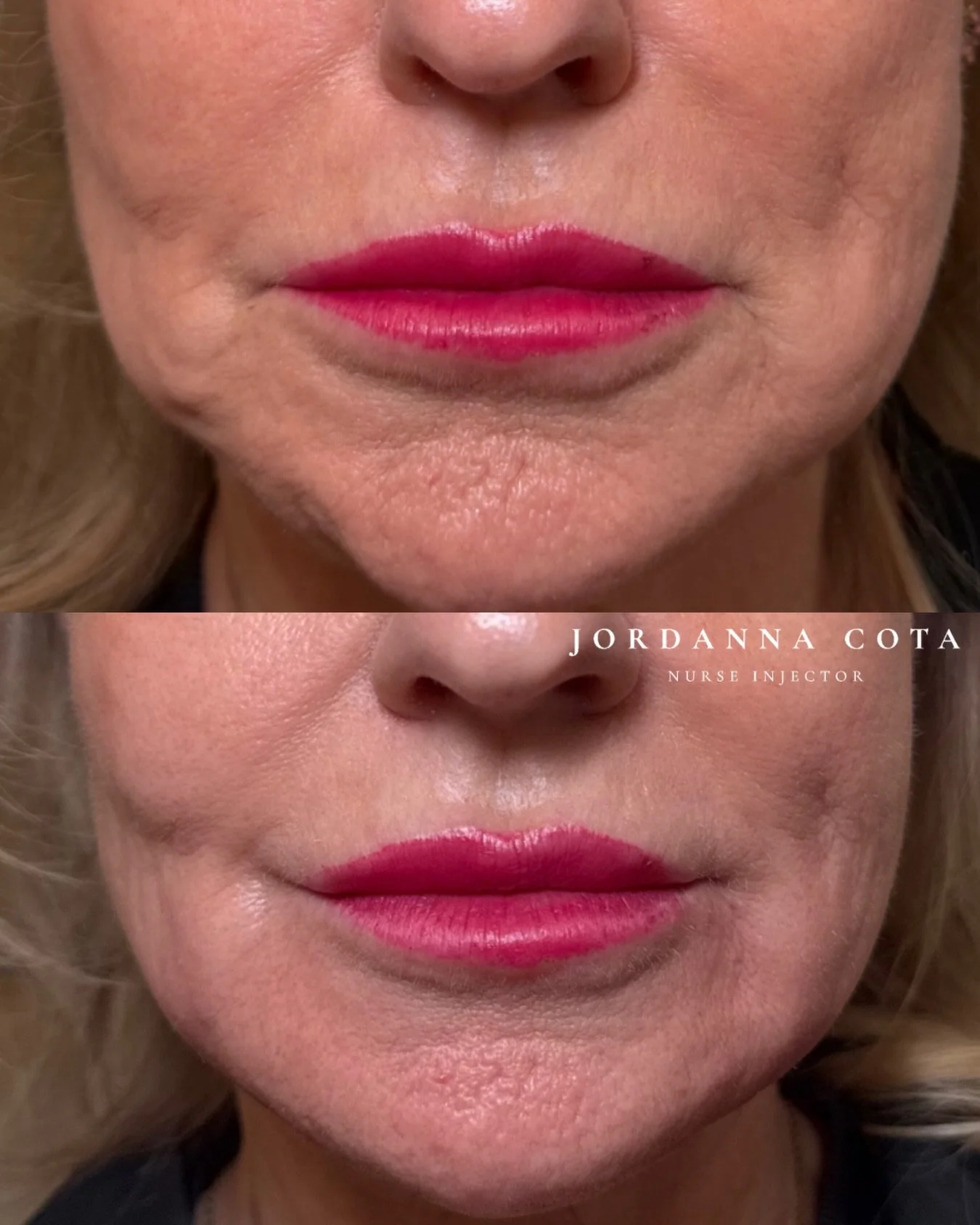 When it comes to treating the lower face with dermal filler, results come down to three things: the right candidate, the right product, and the right placement.

With thoughtful assessment and strategic support, we can soften marionette lines, suppor