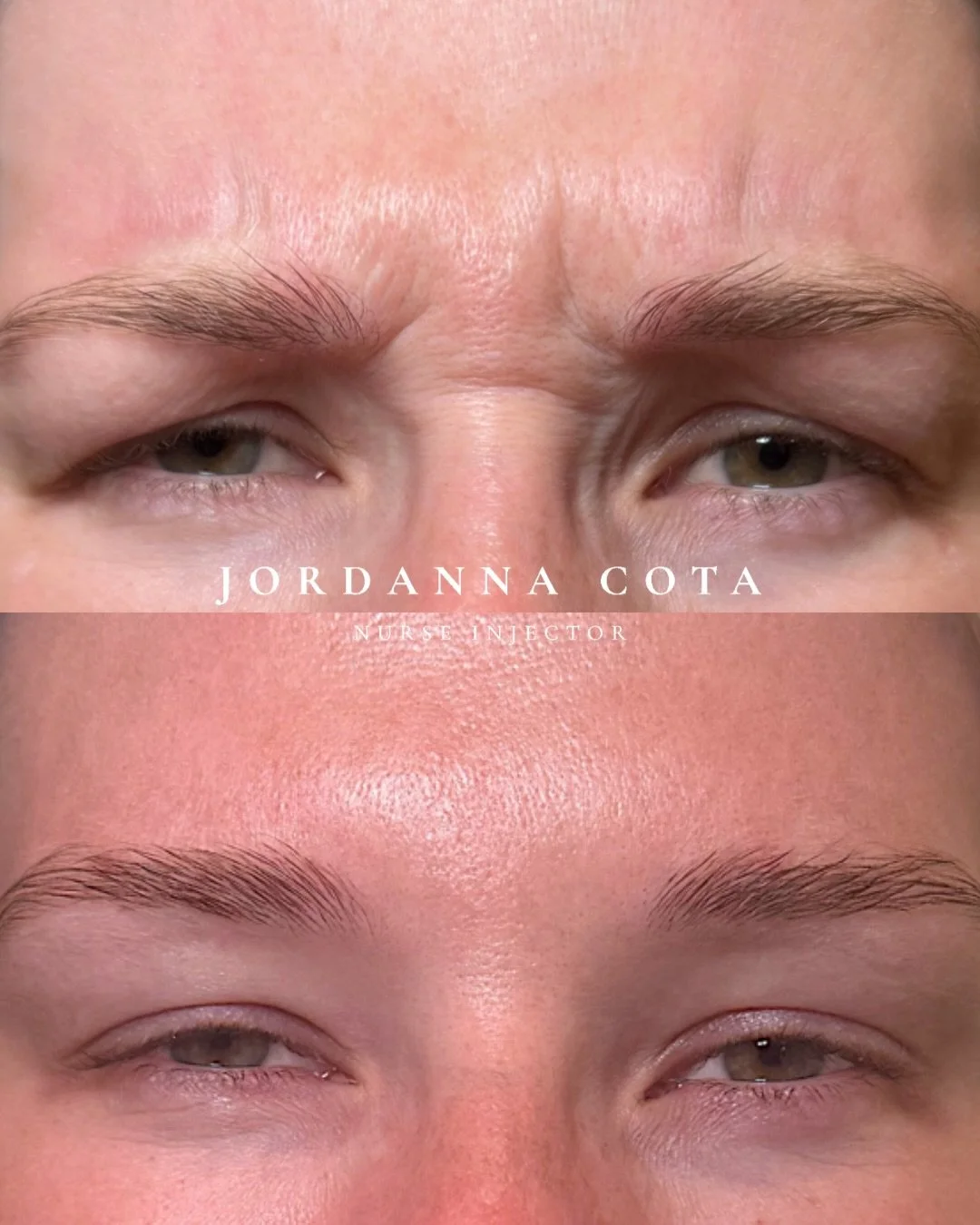 heavy lids? let&rsquo;s talk about it.
this is a perfect example of how neuromodulators can create a subtle brow lift and open the eyes. 

no surgery, just thoughtful placement.
&bull;
&bull;
&bull;
Disclaimer: Before &amp; after images are shared wi