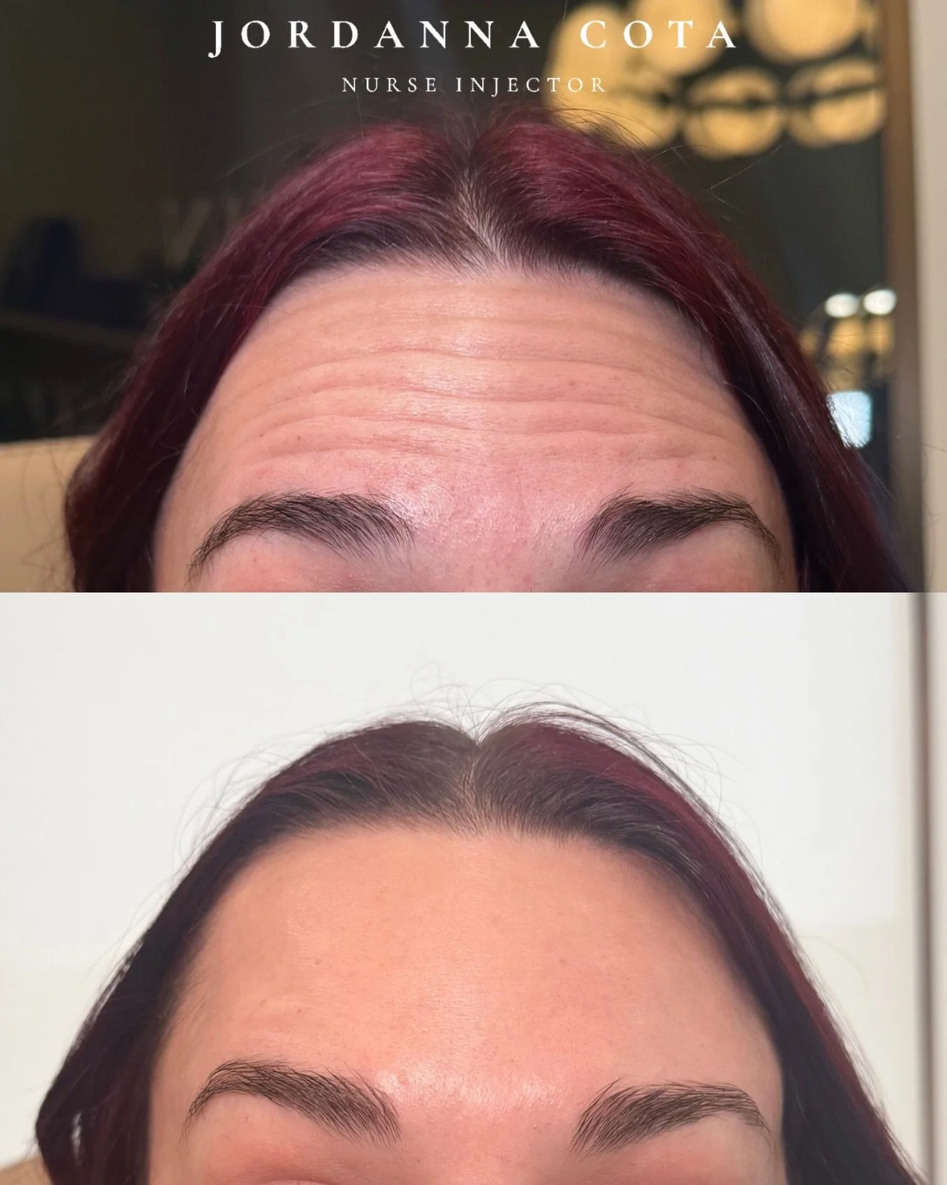 refinement, not restriction.

a softened forehead that still moves, still expresses just without the heaviness of etched lines.
&bull;

&bull;

&bull;
Disclaimer: Before &amp; after images are shared with informed, written patient consent. Results va