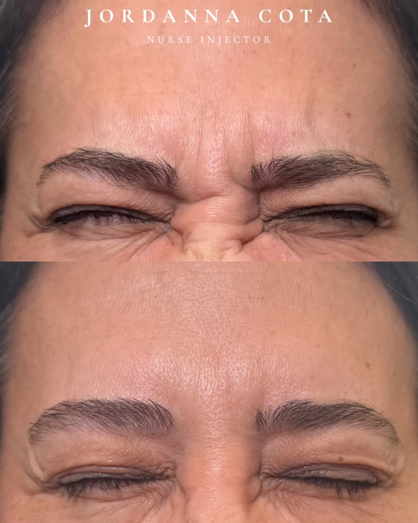 treating the frown lines (the &ldquo;11s&rdquo;) &darr;

over time, the muscles responsible for frowning, the corrugators and procerus become stronger and more dominant with repeated expression

every time you concentrate, squint, or frown, these mus