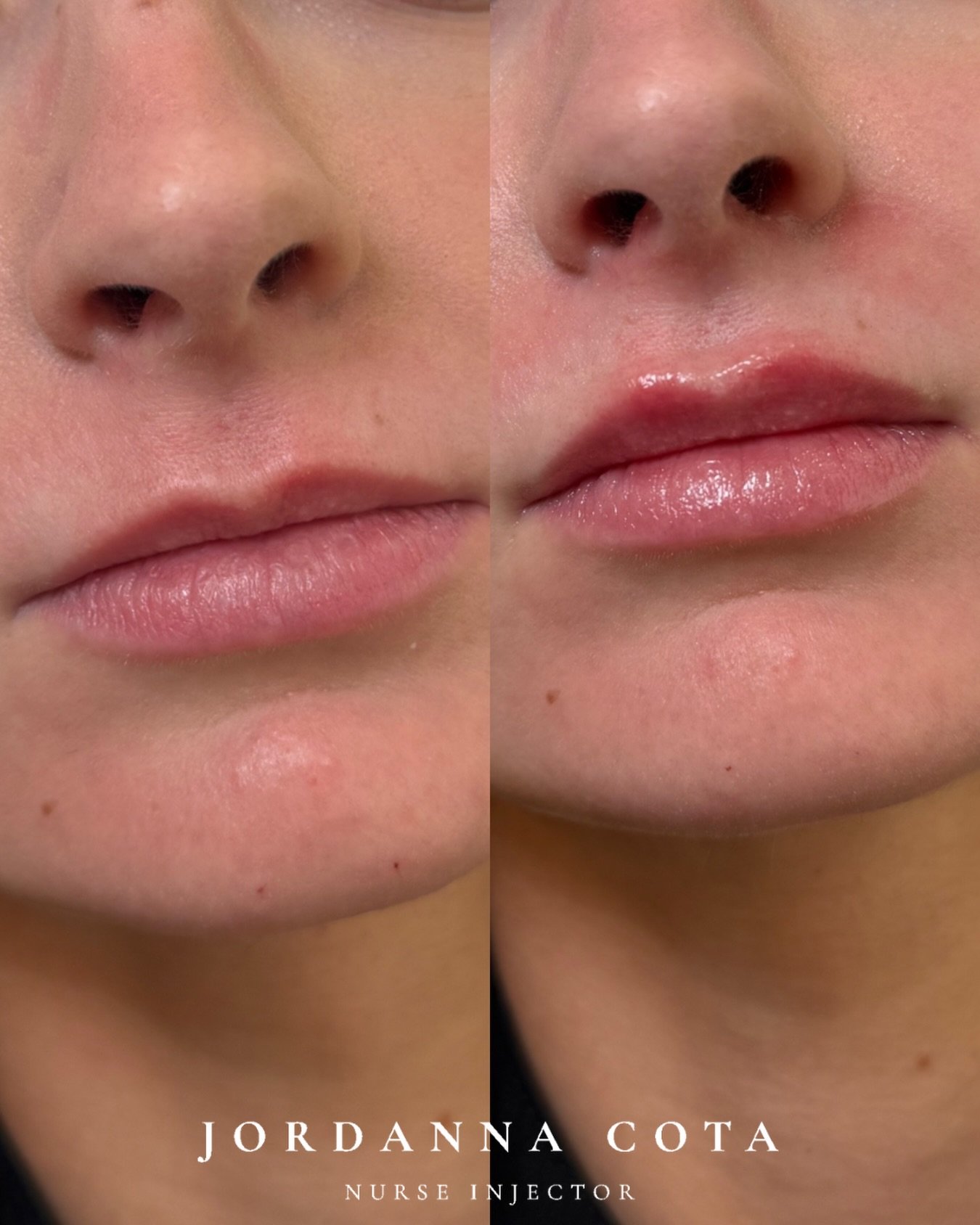 the perfect example of lip filler for symmetry, not volume which in return creates undetectable results.

not every lip needs more volume everywhere. In this case, we treated the top lip only to restore balance and symmetry because beautiful results 