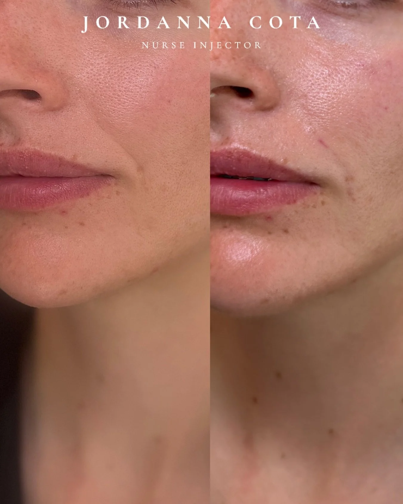 skinvive is designed to enhance skin quality, not erase anatomy

in this before &amp; after you&rsquo;ll see:
&bull; increased luminosity
&bull; improved smoothness
&bull; subtle softening of fine lines

what you won&rsquo;t see? overfilled or altere