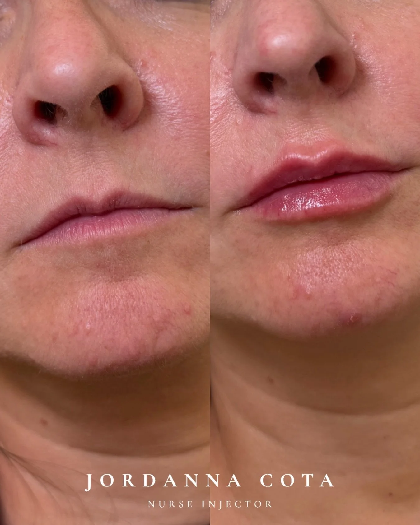 a natural lip outcome often is the result of a treatment plan, not a single treatment.

this transformation was achieved over two treatment sessions, strategically combining neuromodulator with hyaluronic acid filler to address both the muscular infl