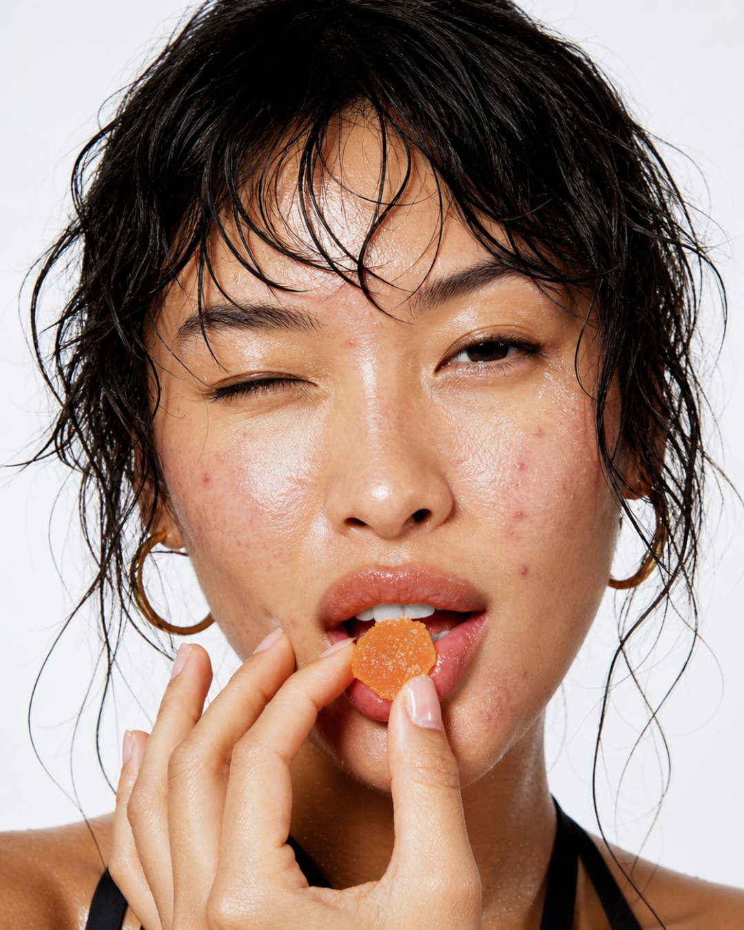 THE ACNE PROJECT