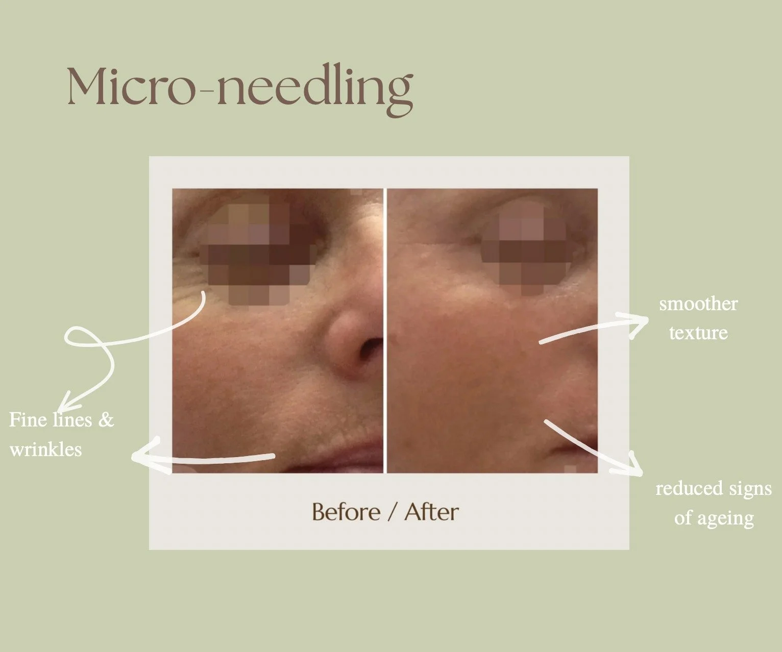 ✨ Microneedling : Collagen Boost in Action ✨

-Safe for all skin types

-Minimal downtime

-Real, lasting results
 
&thinsp;
#pointcook #melbourne #westmelbourne #skincare #skincaremelbourne #skincarewestmelbourne #skincarepointcoom #skincareclinic #