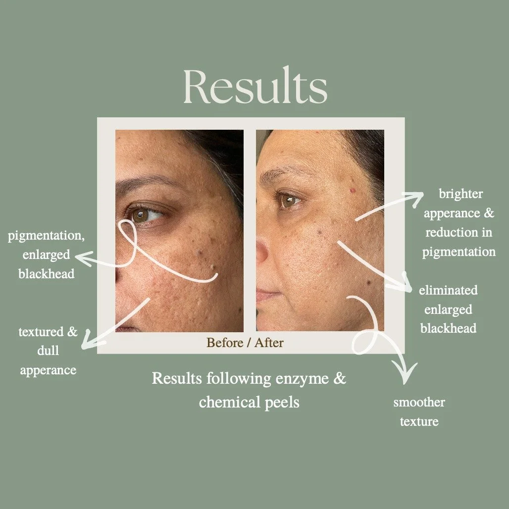 Take a closer look at the results following a customised enzyme &amp; chemical peel treatment plan

#pointcook #melbourne #westmelbourne #skincare #skincaremelbourne #skincarewestmelbourne #skincarepointcoom #skincareclinic #medspa #dermaltherapy #de