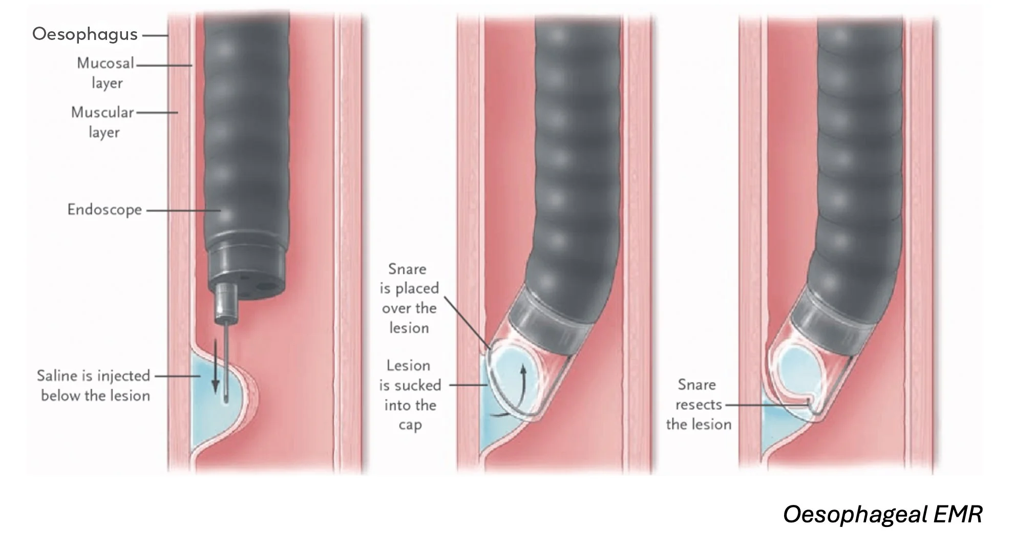 Endoscopic mucosal resection — Leonda Gastroenterology