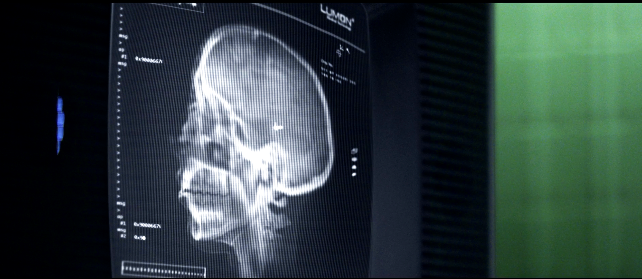A medical scan of a human skull in a side profile view on a monitor.