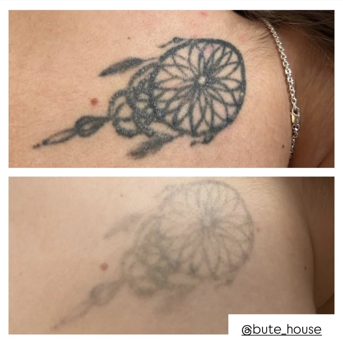 Tattoo removal in Newmarket by Bute House Aesthetics