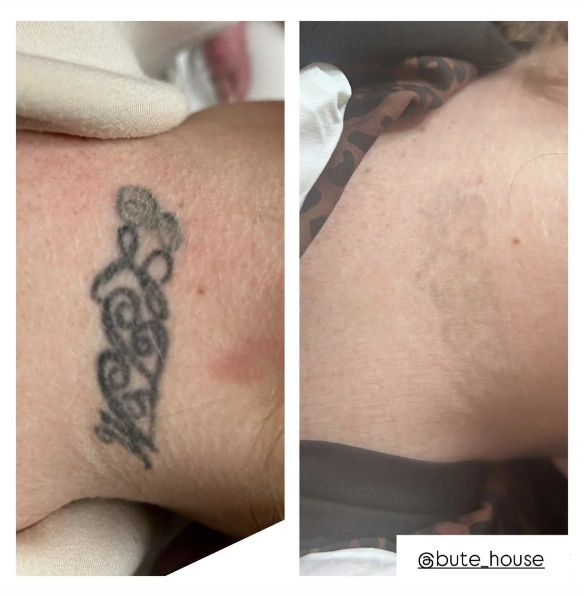 Tattoo removal before and after by Bute House Aesthetics in Suffolk