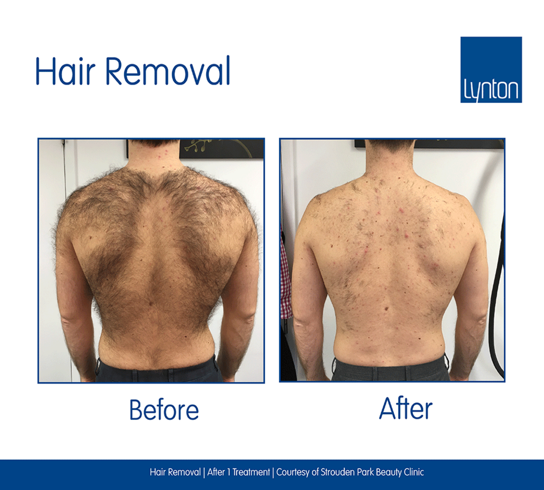 Treamtent-Hair-Removal-Back-Beauty-Clinic.png