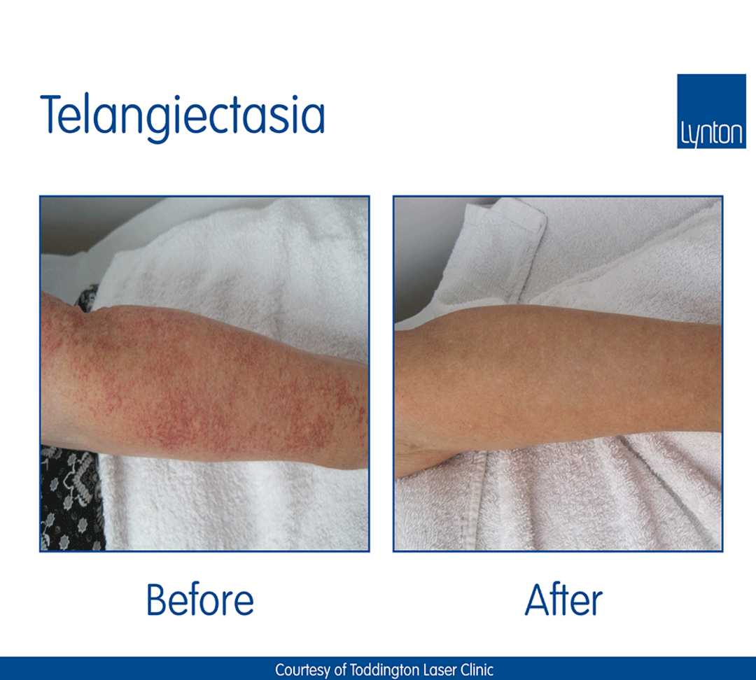 Lumina-B-A-Telangiectasia.png