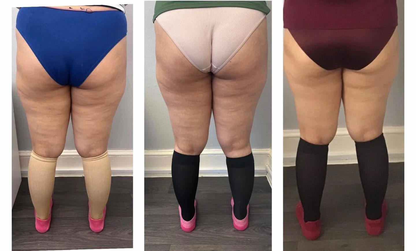 WOW 🤩 
Just look at these results for our client who wanted smoother skin, I think we nailed it?!

She had a course of 4 Slimyonik lymphatic massage on the cellulite program combined with RF (radio frequency) to lift and tighten skin. 
Followed by a