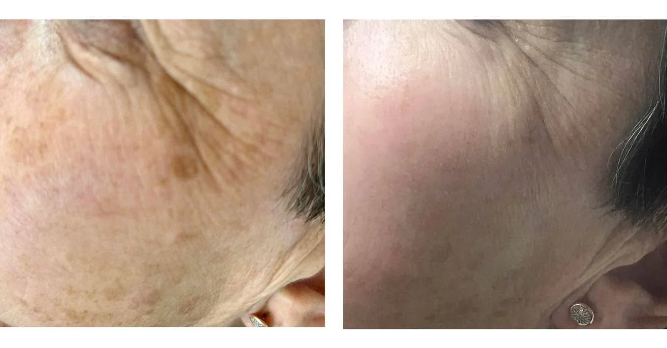 WOW 🤩 
Just look at this fantastic improvement in our clients skin after laser pigmentation treatment!

We have completed two sessions so far and will do one more to remove any remaining patches and rejuvenate skin ✨

BOOK NOW - this is the perfect 