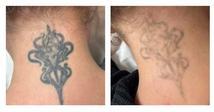 ‼️BOOK NOW &mdash; BOGOF‼️
More than one tattoo regret?? 
No problem, this October we have buy one get one free on all of our laser courses! 

Start your laser tattoo removal now with our highly qualified &amp; experienced team, using certified laser