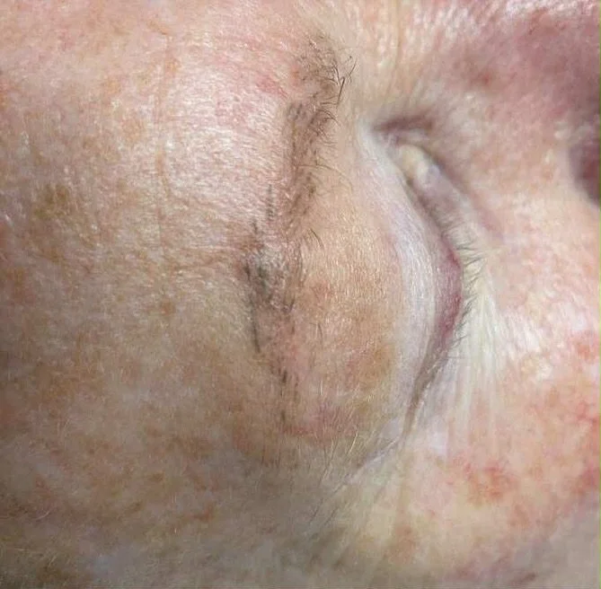 Microbladed brows gone in one☝️ 🪄 ⚡️ 
#laserbrowremoval #tattooremoval #spmu #brows #microblading #freshstart #laserclinicsuffolk #newmarket