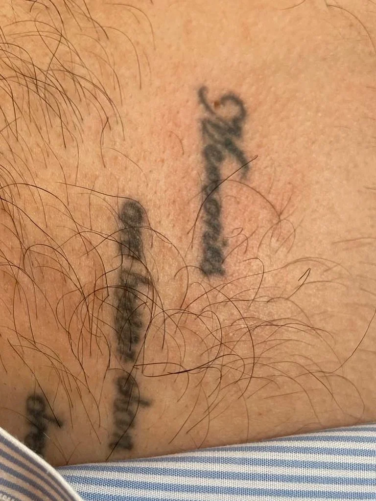SWIPE TO SEE THIS REMOVED 😍
Tattoo removal complete ✔️🙌
Another great result for our client this week, book now to secure your bogof offer!

#tattoo #laserclinic #tattooremoval #newmarket #lasertreatments #nomoreregrets #freshskin