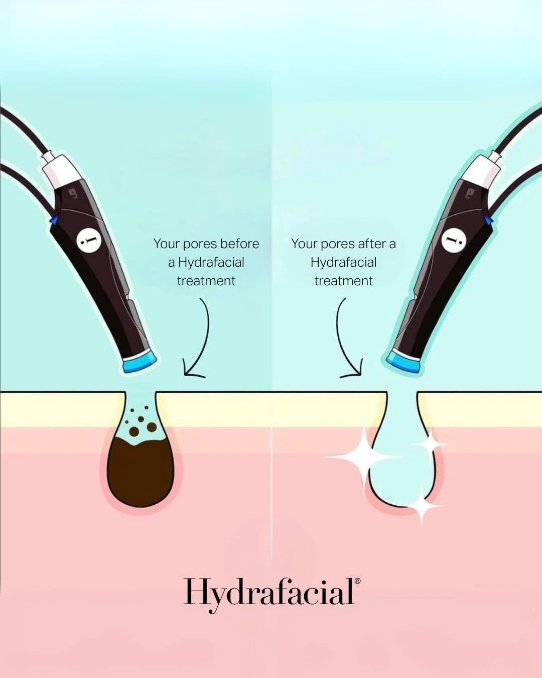 Pore perfection made easy: non-invasive, painless, zero downtime &hellip; just in time for that weekend glow ✨

@hydrafacial_uk #hydrafacialuk #hydrafacial #skintreatment #healthyskin #skinhealth #skincare #LVBXUK