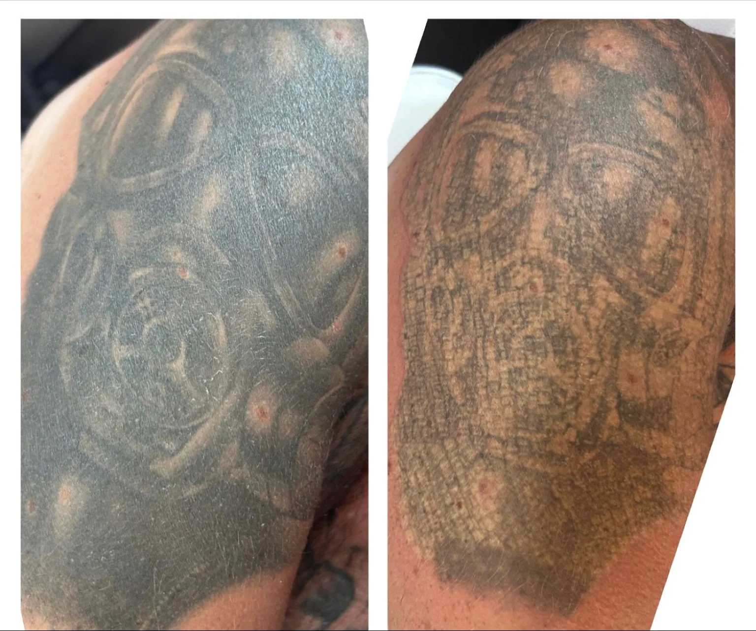 How amazing is this immediately after first session!
#lasertattooremoval #tattoo #tattooregret #laserclinic #lynton #dekalaser