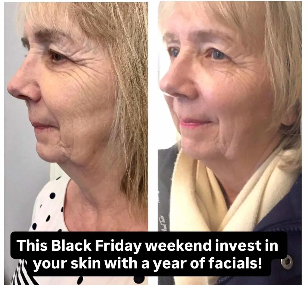 ❄️🌱This Black Friday weekend invest in your skin with Bute House ☀️🍂

A YEAR OF FACIALS

We are giving you a limited chance to book your next years worth of facials at an incredible price:

X2 Dermapen (thicken &amp; Strengthen)

X2 HydraFacial Pla
