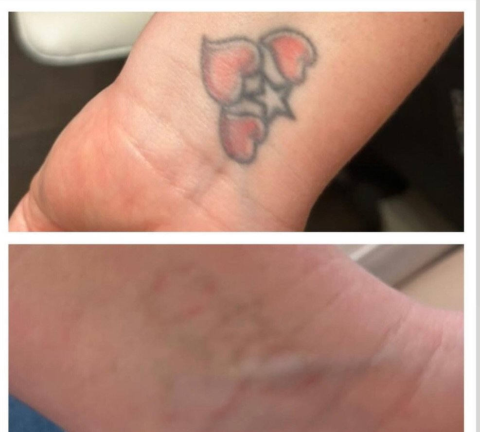 Amazing results after just 2 sessions! 

We left 8 weeks between 1st &amp; 2nd session.
Our Client then returned today, 8 Months after her second session, due to a busy schedule.
As you can see the body has continued to fade and get rid of the ink an