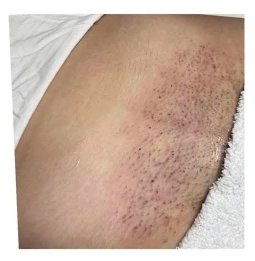 Do you suffer with: #ingrownhair #razorbumps #dailyshaving #waxing #thickcoarsehair 

We&rsquo;ve got you 💪
This January we launched our full pay monthly MEMBERSHIP on all single areas of laser hair removal, not just packages. 

PLUS book by the end