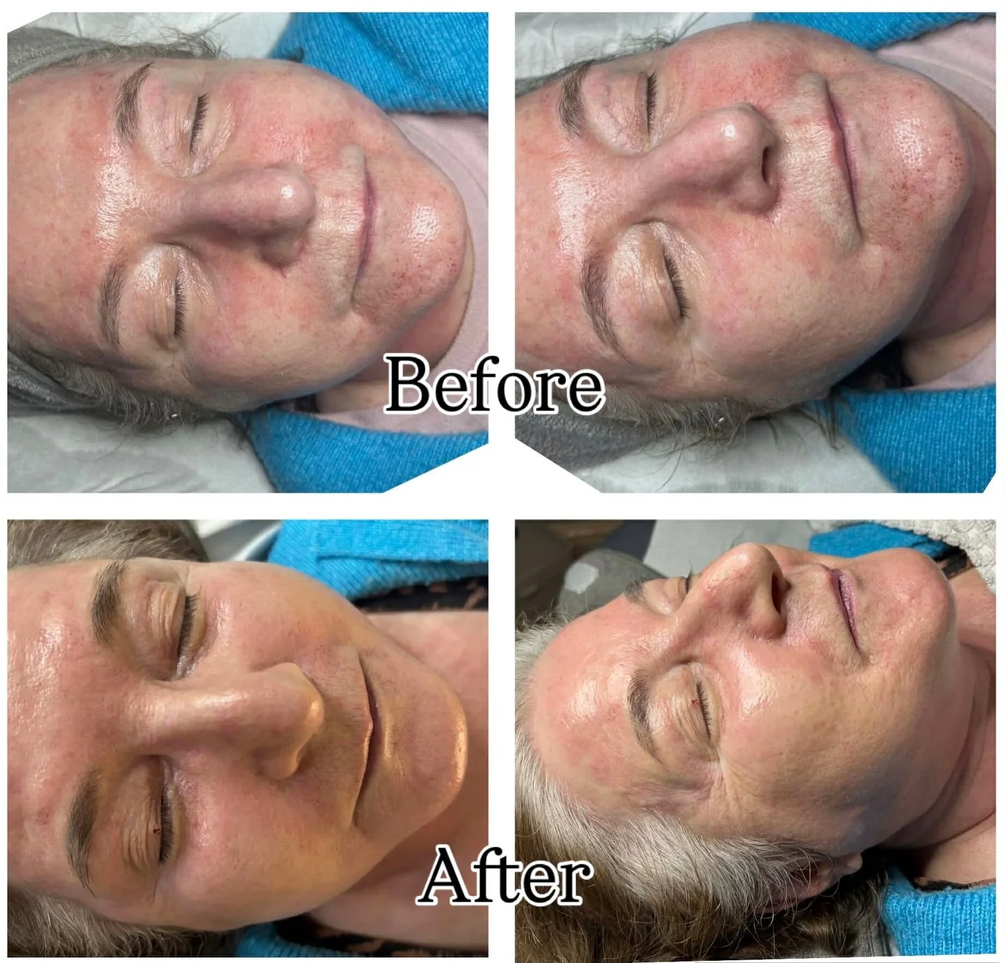 🤩 Look at the improvement of our clients skin after two sessions of Dermapen Micro-needling!

This client suffers with Rosacea, redness and delicate skin, but now her skin density is nice and plump and Rosacea is dramatically improved ✨

#microneedl