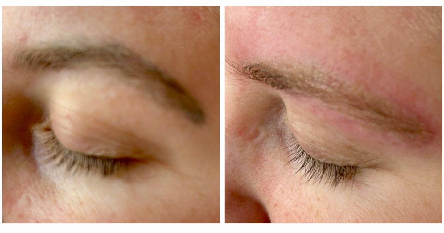 Tattoo Brows gone in one!! 

⚡️Book now - &pound;55 per session
⚡️Free patch test 
⚡️DM to book 

#lasertattooremoval #tattooregret #spmubrows #tattoobrow #microblading