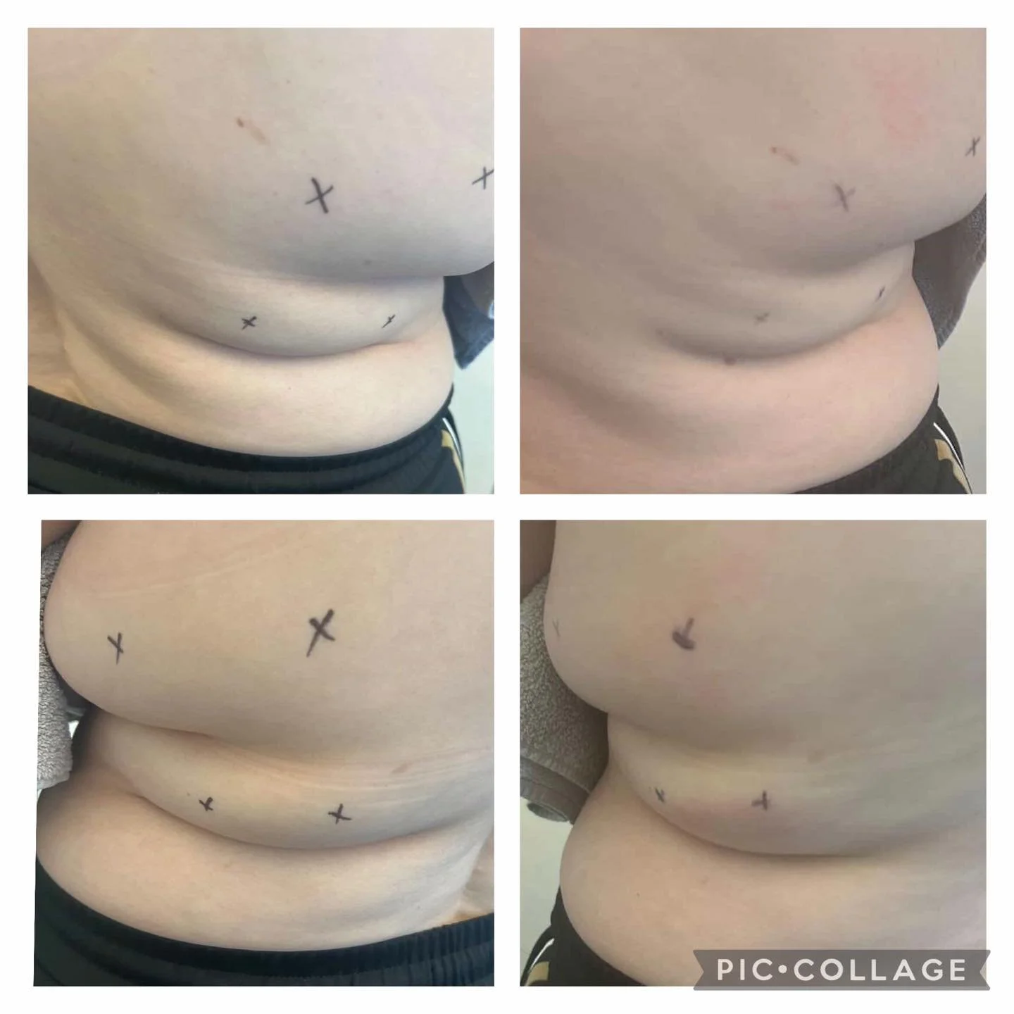 ‼️Before and After‼️
1st session of Cavitation on bra bulge area from our content model day🤩

We recommend a course of 4 or 8 sessions for best results 1 per week, adding a Cryo Freeze will improve results further. We will take progress pictures thr