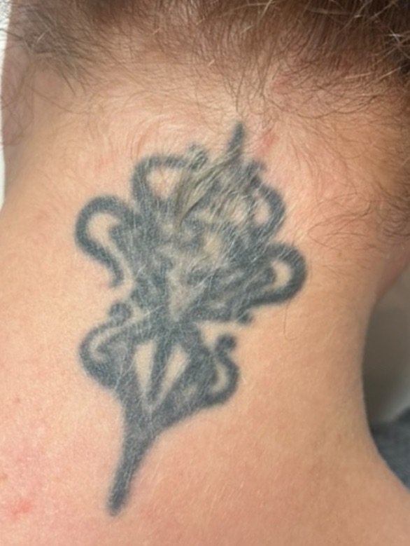 From BOLD ink to barley there - Real results @bute_house 

⚡️Start today and make tattoo regret a thing of the past ⚡️ 
#tattoo #tattooregret #coverup #laserclinicnearme