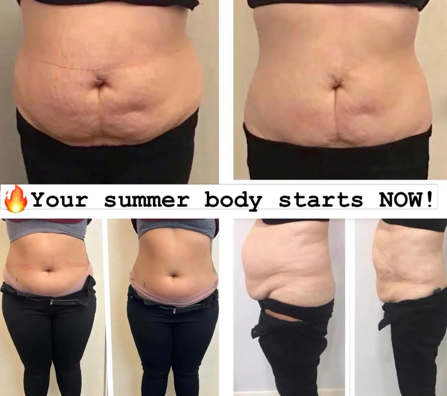 🚨 BANK HOLIDAY BODY SCULPTING DEALS 🚨

Sculpt, tone &amp; tighten with our non-invasive treatments

🔥 Book 4 Cavitation Sessions
&rarr; Get 4 FREE (save &pound;380)

💎 Book 8 Cavitation Sessions
&rarr; Get RF Skin Tightening + 4 Slimyonik Session