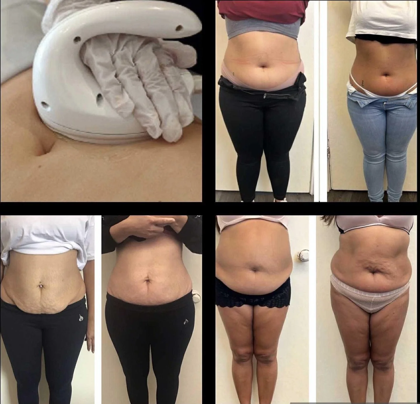 🚨 BANK HOLIDAY BODY SCULPTING DEALS 

Sculpt, tone &amp; tighten with our non-invasive treatments

🚨Book 4 Cavitation Sessions
&rarr; Get 4 FREE (save &pound;380)

🚨Book 8 Cavitation Sessions
&rarr; Get RF Skin Tightening + 4 Slimyonik Sessions FR