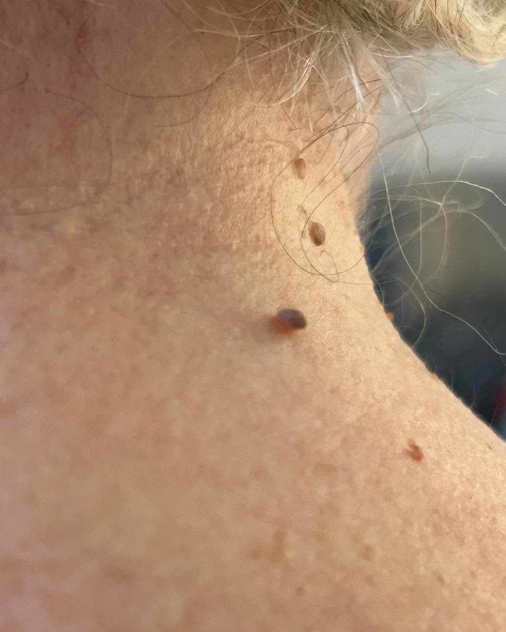 #skintagremoval Bute House Aesthetics
These annoying little tags can be easily removed using our #plasmapen 
Multiple can be removed in one session so don&rsquo;t put up with them, get booked in 🙌

*all in pic were removed but Bev forgot the after p