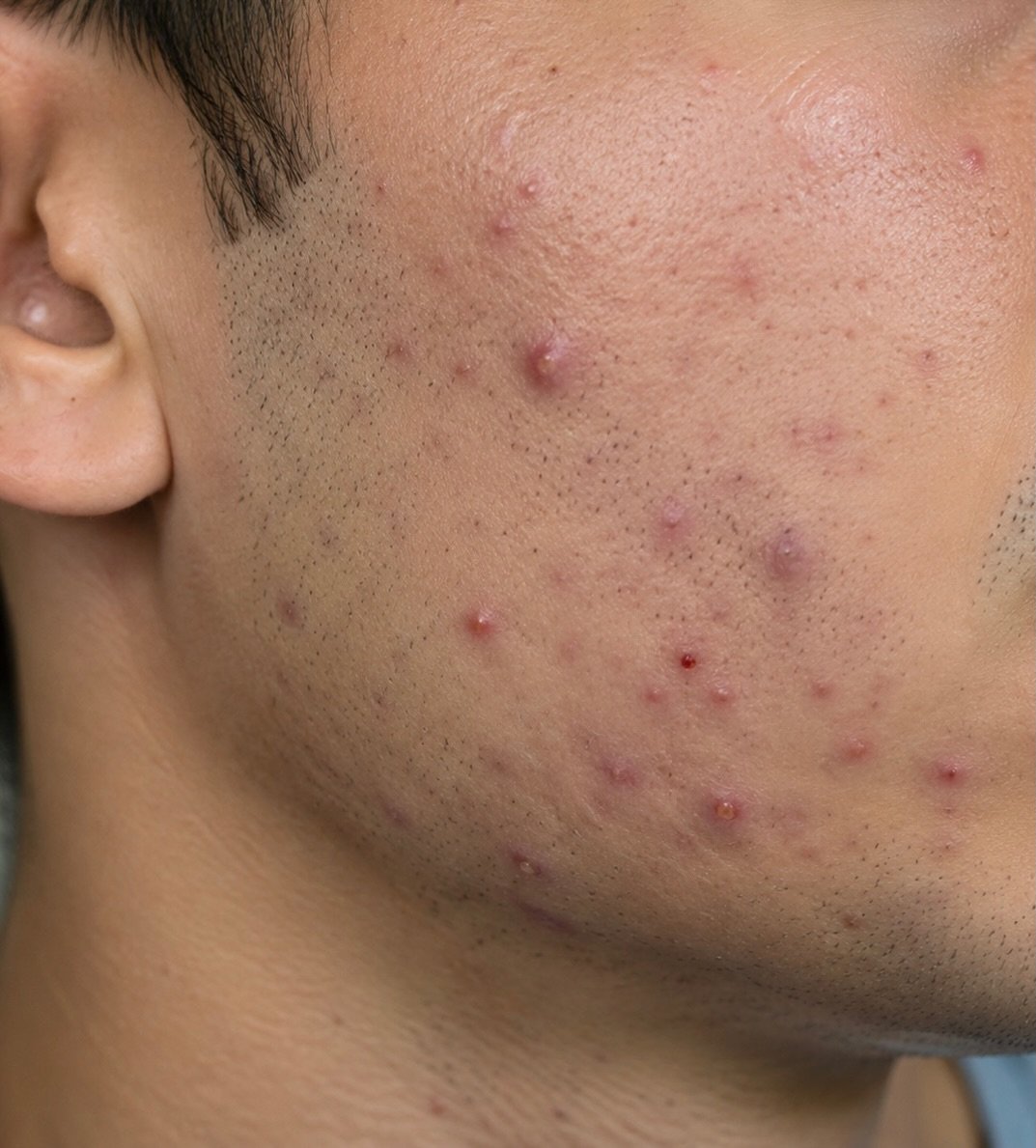 MODEL OPPORTUNITY 

(In preparation for June Acne Awareness Month)

We are looking for 1&ndash;2 acne prone skin models to begin a professional skin improvement journey this May.

This will include:
✔ Advanced laser treatments
✔ Professional iS Clini