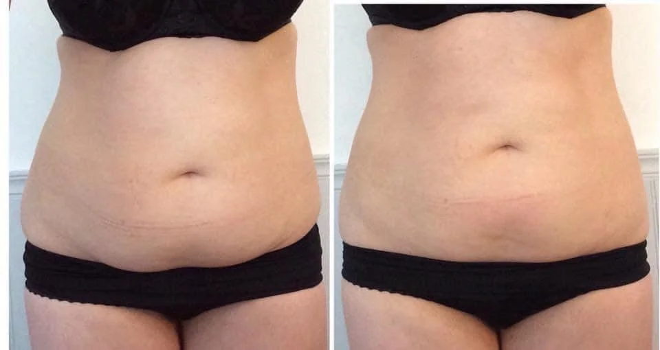 ‼️ BANK HOLIDAY OFFER ‼️

☀️ Get  holiday ready with 50% a course of four Cavitation body sculpting or RF skin tightening! 

You&rsquo;ve got 3 days to grab this deal so DONT miss out 🤩

Book online NOW for automatic discount!