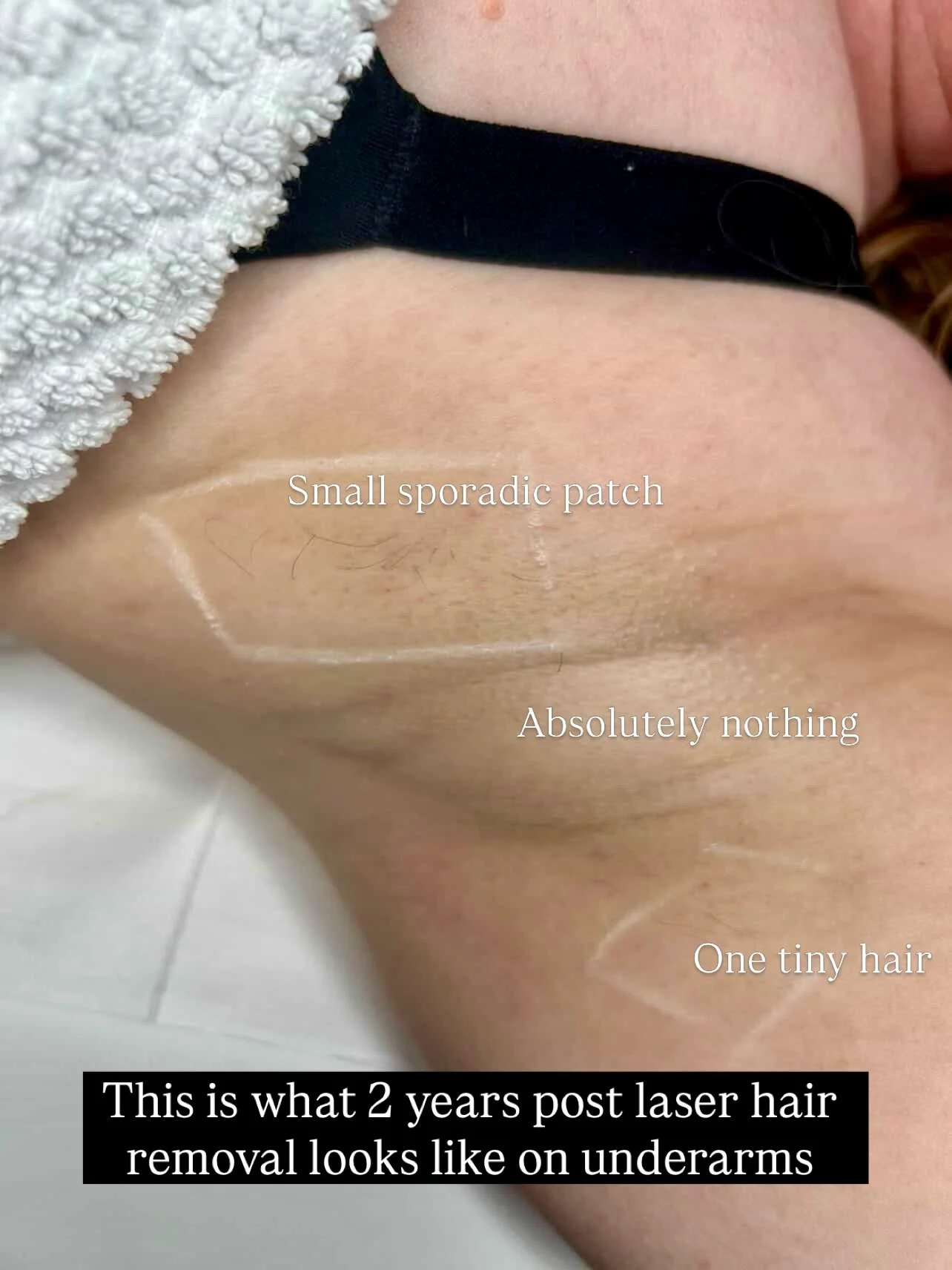 🚨FREE - underarm laser hair removal course 🚨
When you book any other area this bank holiday weekend! 

Plus 50% off ALL maintenance sessions as standard 

🚨Book any other area online this weekend and get an automatic course of underarm laser hair 