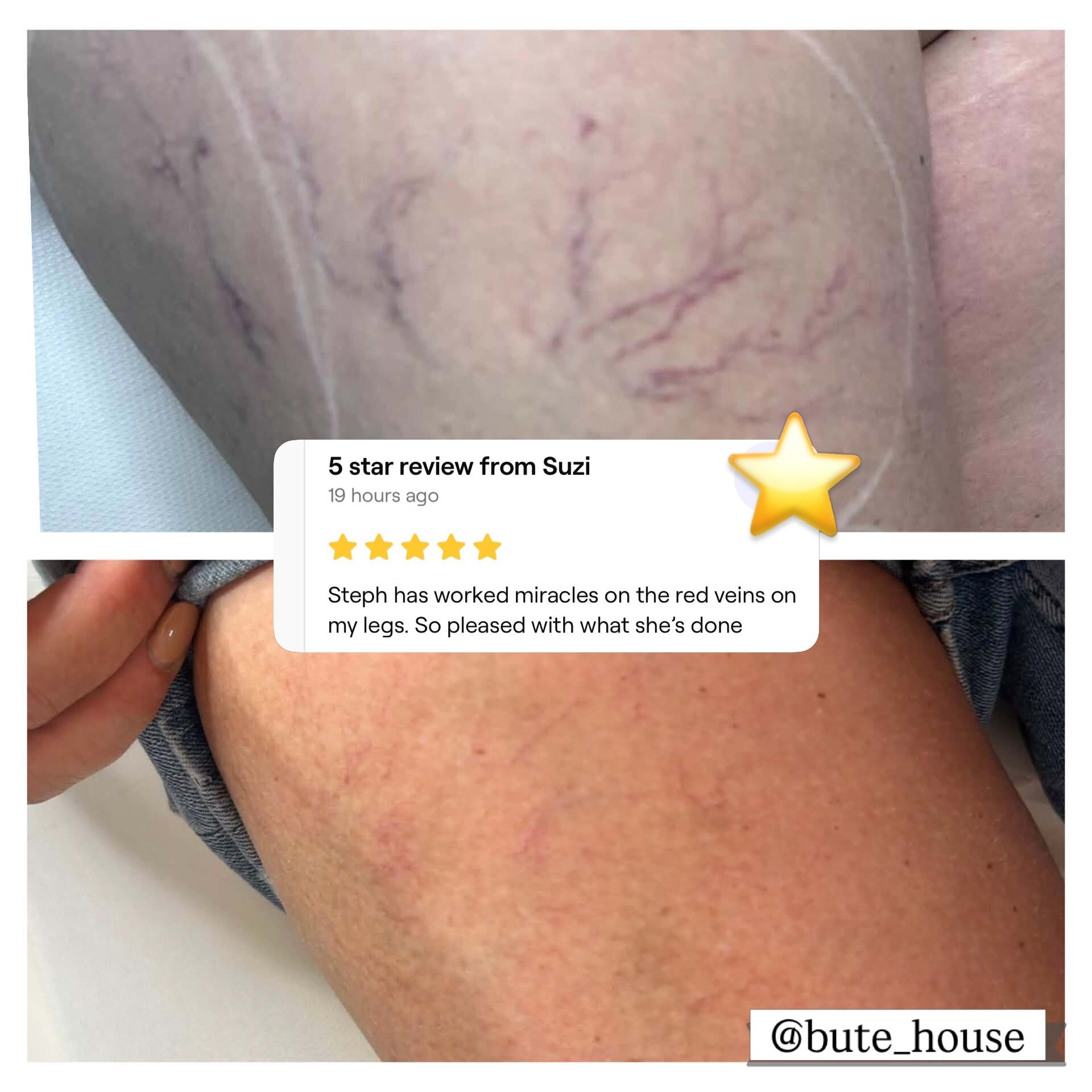 💖 Results like these make our job so special, Steph&rsquo;s client is over the moon and who wouldn&rsquo;t be! 

Prices from just &pound;125 using medical lasers and highly qualified staff.

Dm to get booked in now ⭐️