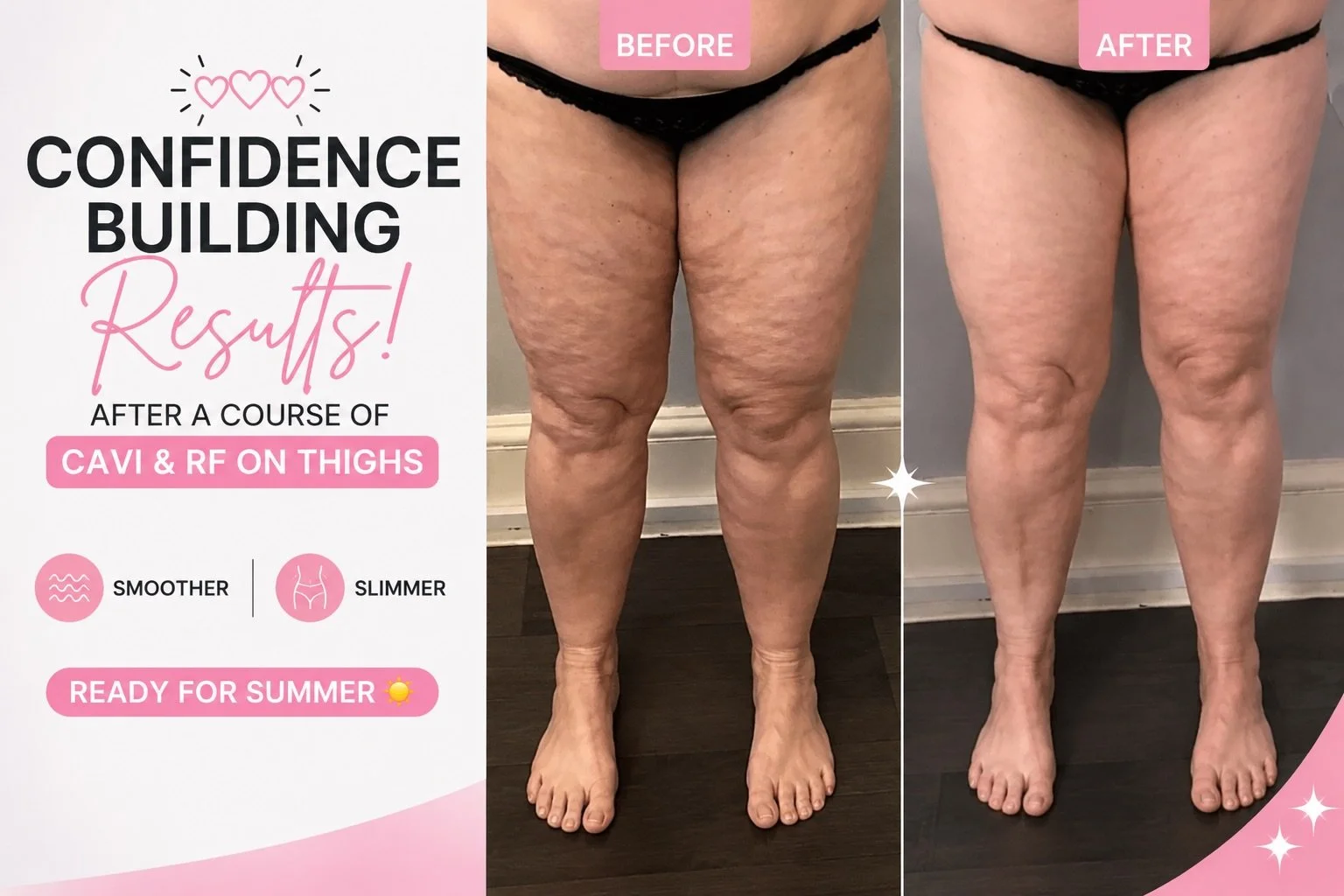 ✨ Confidence-building results! ✨

Just look at the difference after a course of Cavitation &amp; Radio Frequency treatments on the thighs 💕

Helping to improve the appearance of skin texture and create a smoother, more contoured look &mdash; holiday