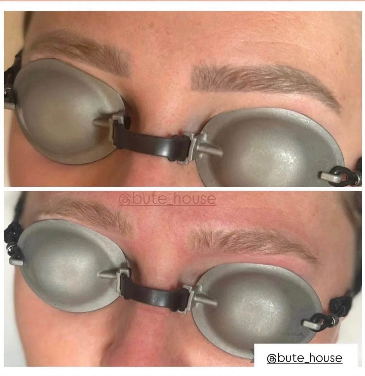 Laser Brow Removal ⚡️
Did you know it&rsquo;s not just Tattoos we remove?! 

Book your consultation &amp; patch test today - Link to book in bio ✔️

#laserclinic #spmu #laserremoval #tattooremovalbeforeandafter #tattooremovalspecialists
