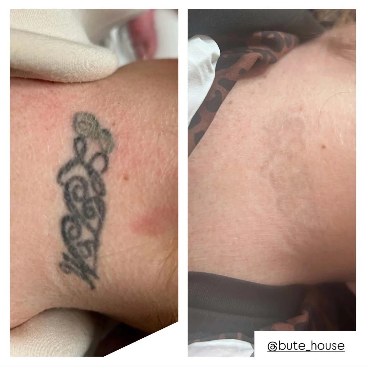 One space available Saturday 12th at 10am for a Tattoo Removal Consultation ⚡️

✅ Pay in 3 available 
✅ Unlimited tattoo removal courses
✅ Tattoo fade short courses 
✅ Single sessions for pre-treated tattoos 

DM to get booked in now 👌

#tattooremov