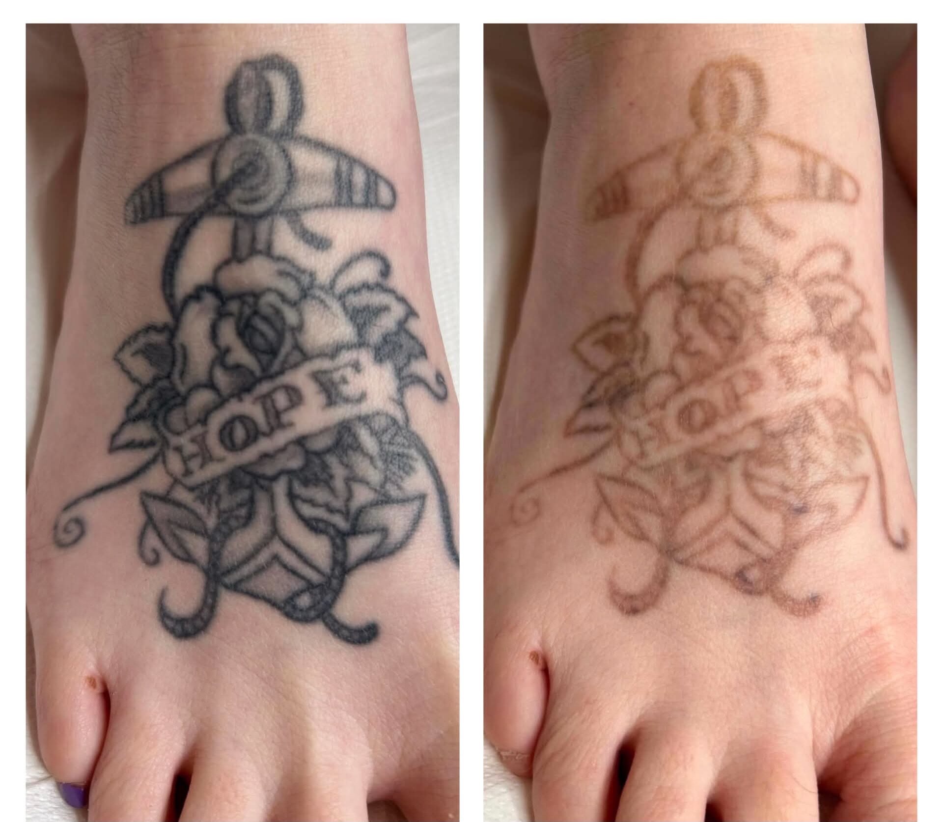 ⚡️Laser tattoo removal @bute_house⚡️

Our client is so happy after just 3 treatments! 

Now is the perfect time to start your #lasertattooremoval 
Cooler temperatures mean a more comfortable post treatment experience.

Book your consultation and patc