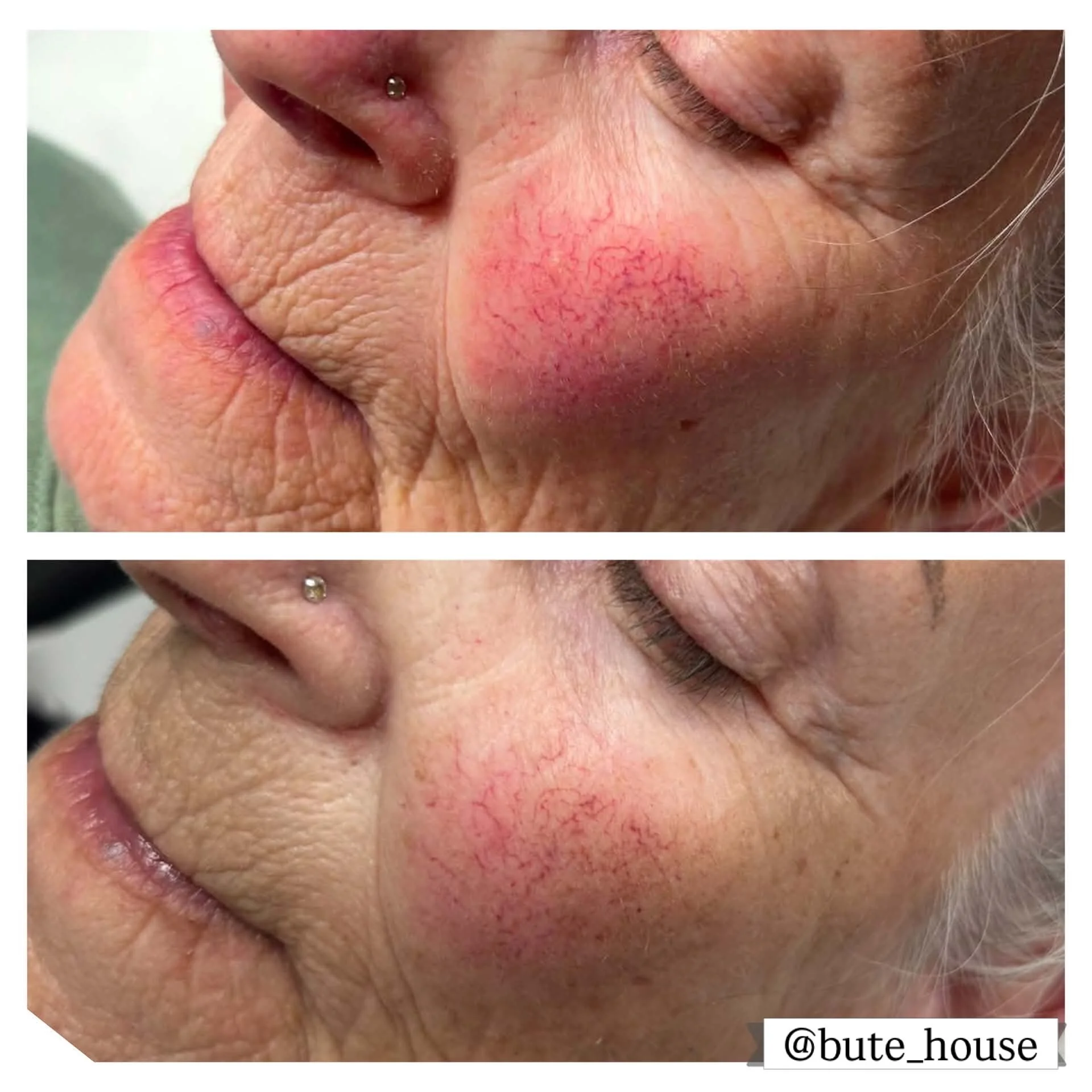 Laser Vein treatment for broken capillaries &amp; rosacea @bute_house ✨

DM for a consultation or more info!