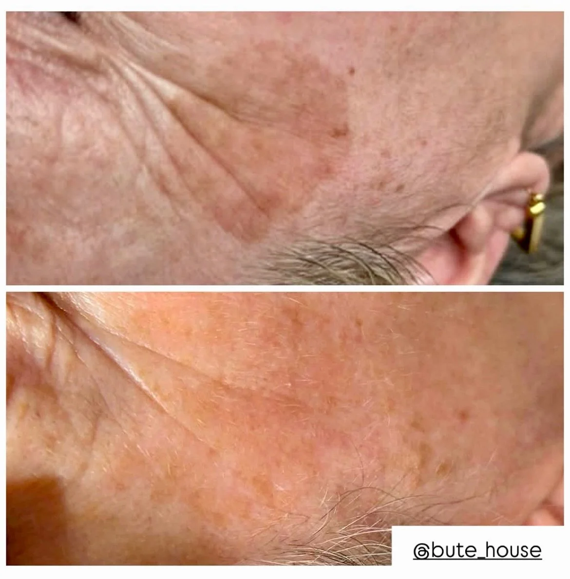 ⚡️LASER SEASON⚡️

It&rsquo;s the perfect time of year to deal with facial imperfections that are bothering you!

⚡️Long hot summers = #sunspots #pigmentation 

⚡️Out dated brows = #lasertattooremoval #spmubrows 

⚡️Sunshine &amp; summer indulgence = 