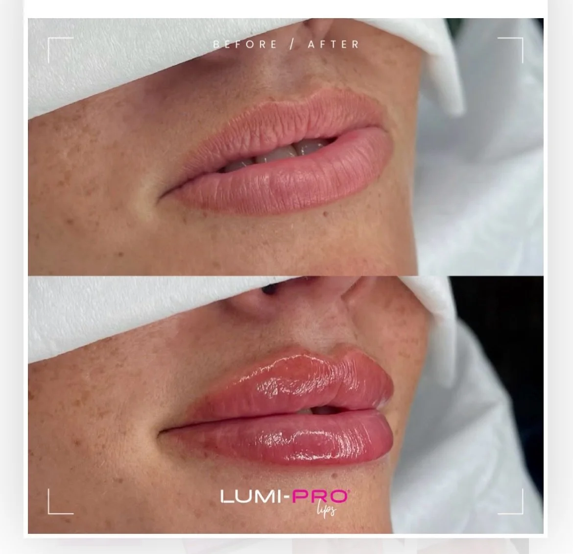 NEW BRAND UPDATE 💋
Next Friday @nataliemarieaesthetics will be back in clinic and she&rsquo;s bringing a fresh new brand to enhance your dermal filler results! 

LAUNCH OFFERS 🎉
To celebrate the introduction of @lumifil_uk she has a limited time mo