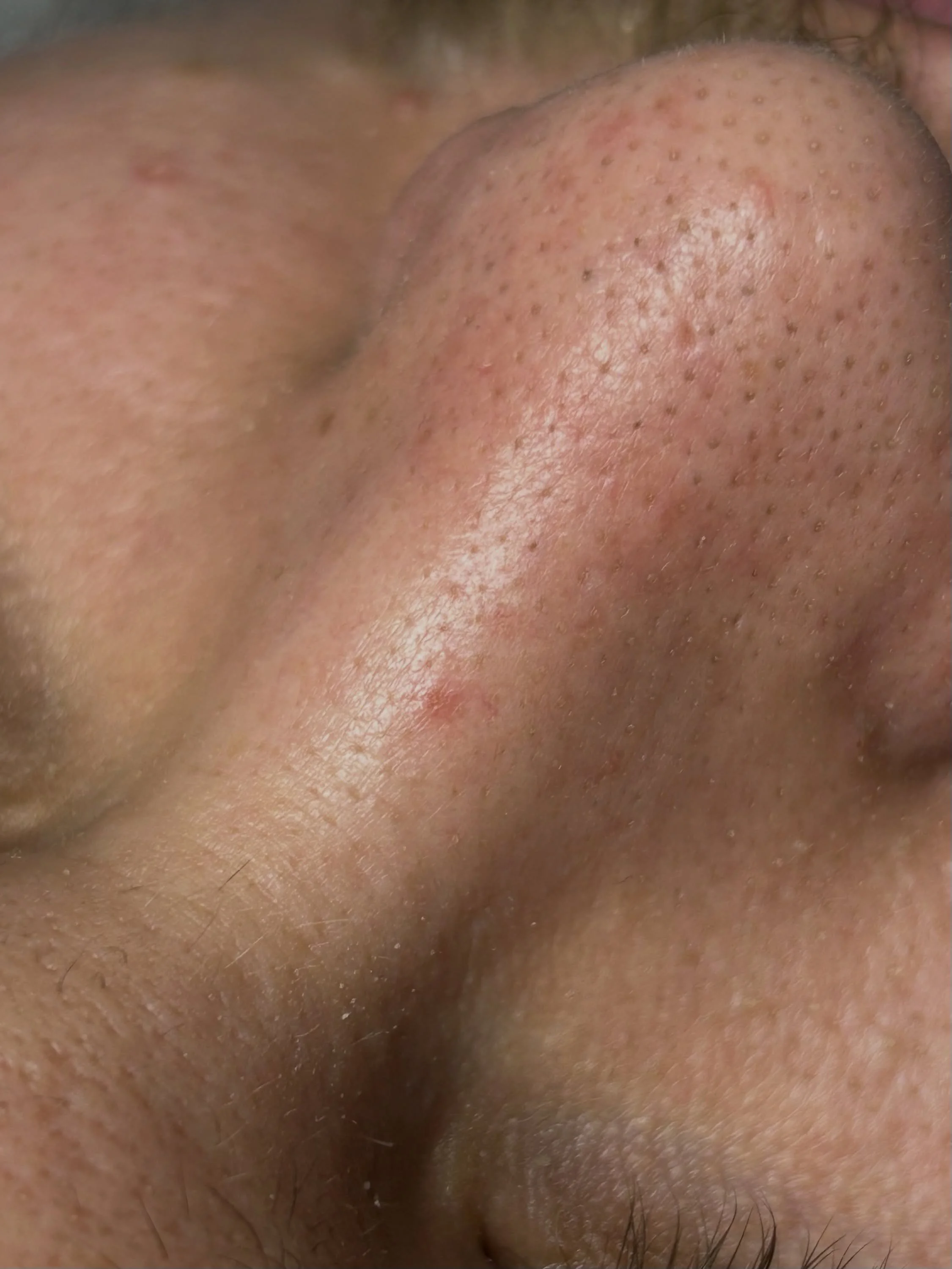 #hydrafaci̇al &hellip;