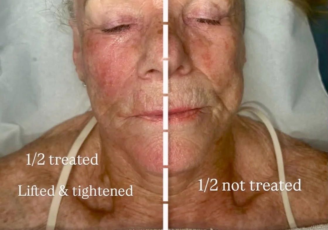 Have you heard of Radio Frequency? 

#radiofrequency (RF) energy is used to heat the deeper layers of your skin, helping to stimulate collagen production and improve skin firmness, texture and smoothness.

If you&rsquo;re a loyal client of @bute_hous