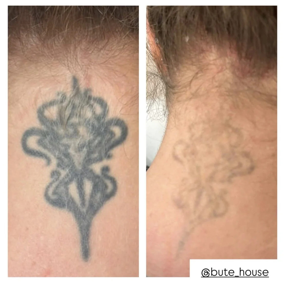 Black tattoo removal by Bute House Aesthetics in Suffolk